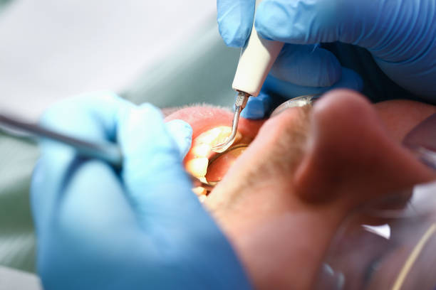 Best Emergency Tooth Extraction in Westwood, CA